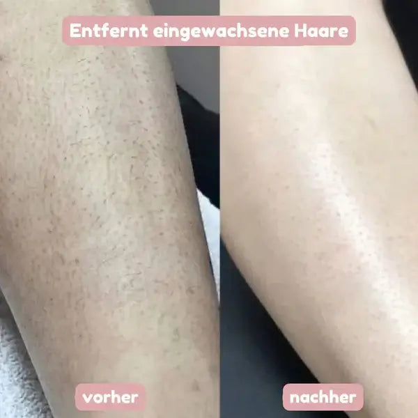 Vorher-nachher-Vergleich an einem Bein: links Haut mit eingewachsenen Haaren, rechts glatte Haut nach der Rasur.