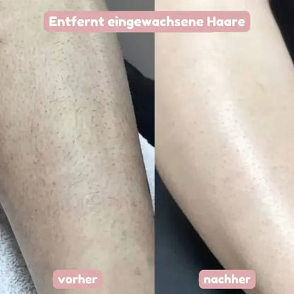 Vorher-nachher-Vergleich an einem Bein: links Haut mit eingewachsenen Haaren, rechts glatte Haut nach der Rasur.