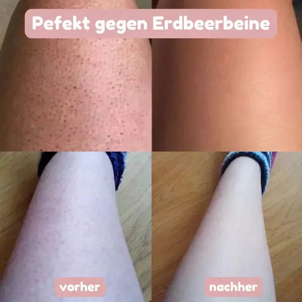 Vorher-nachher-Vergleich an Beinen: links Haut mit dunklen Pünktchen, rechts deutlich glattere Haut nach der Anwendung.