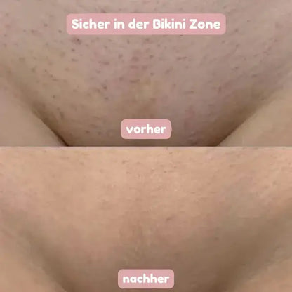 Vorher-nachher-Vergleich im Bikinibereich: oben Haut mit Stoppeln und Rötungen, unten sichtbar glattere, gleichmäßigere Haut.