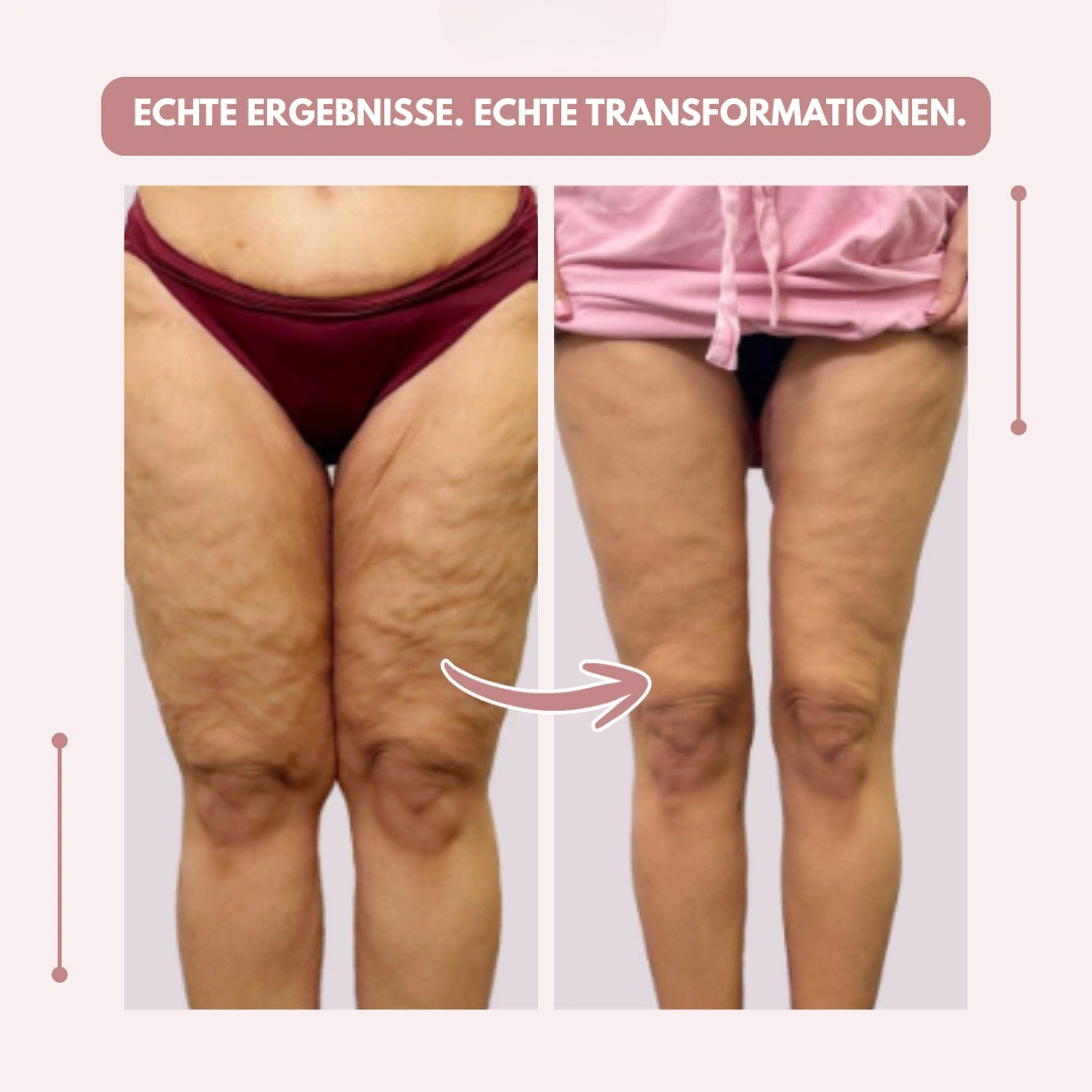 Vorher-nachher-Vergleich der Oberschenkel von vorn, links mit sichtbarer Hautstruktur, rechts glattere Beine unter einem rosa Shirt. 12