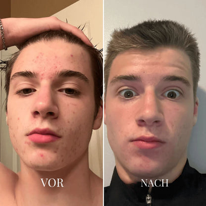 Vorher-Nachher-Vergleich eines jungen Mannes: links Hautunreinheiten auf Stirn und Wangen, rechts deutlich klarere Haut 3