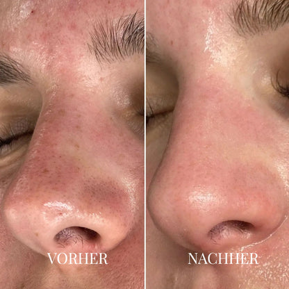 Vorher-Nachher-Vergleich einer Nase in Nahaufnahme: links sichtbare Poren und Rötungen, rechts glattere, klarere Haut 2